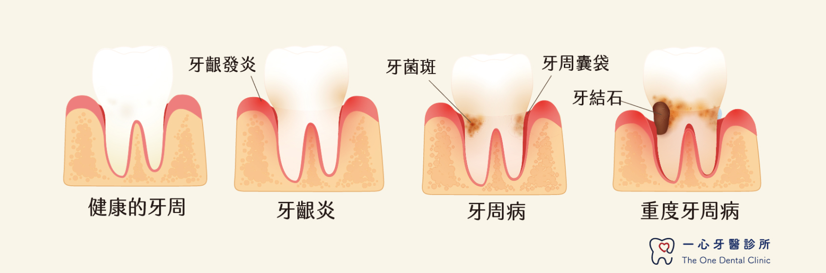 牙周專科介紹｜診療項目｜一心牙醫- The One Dental